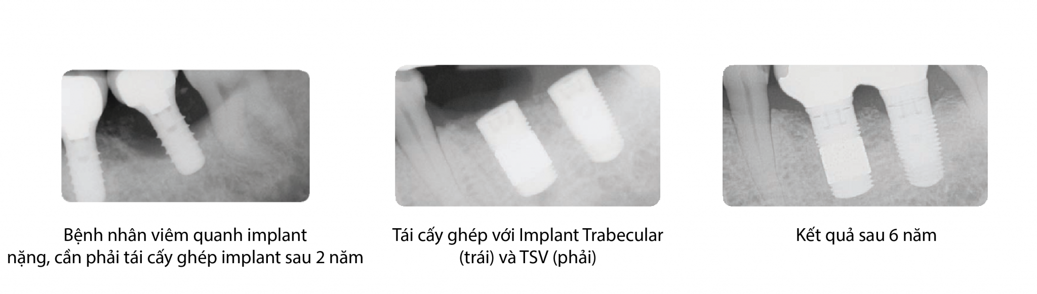 Trabecular Metal Implant ZimVie Viet Nam